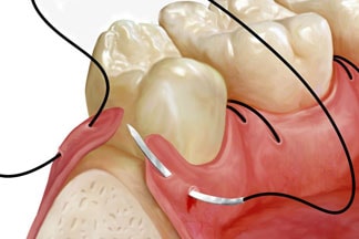Oralchirurgie