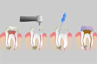Endodontik Tedavi - Kanal Tedavisi