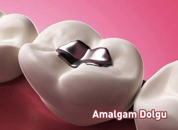 Amalgam Dolgu Fiyatları 2018