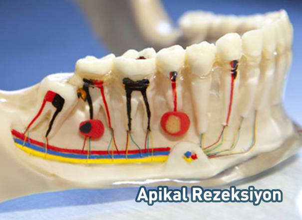 Apikal Rezeksiyon Fiyatı 2018