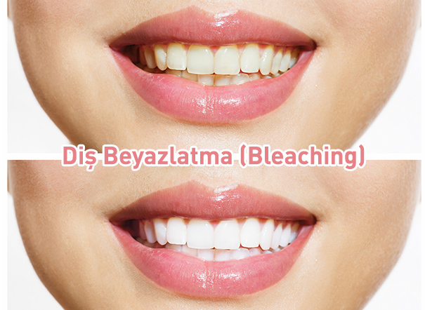 Diş Beyazlatma (Bleaching) Fiyatları (TDB)