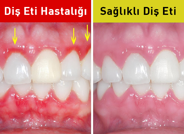 Dişeti Hastalığının Nedenleri Nelerdir?