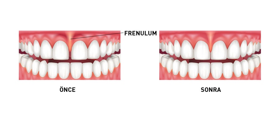 Frenektomi Nedir?